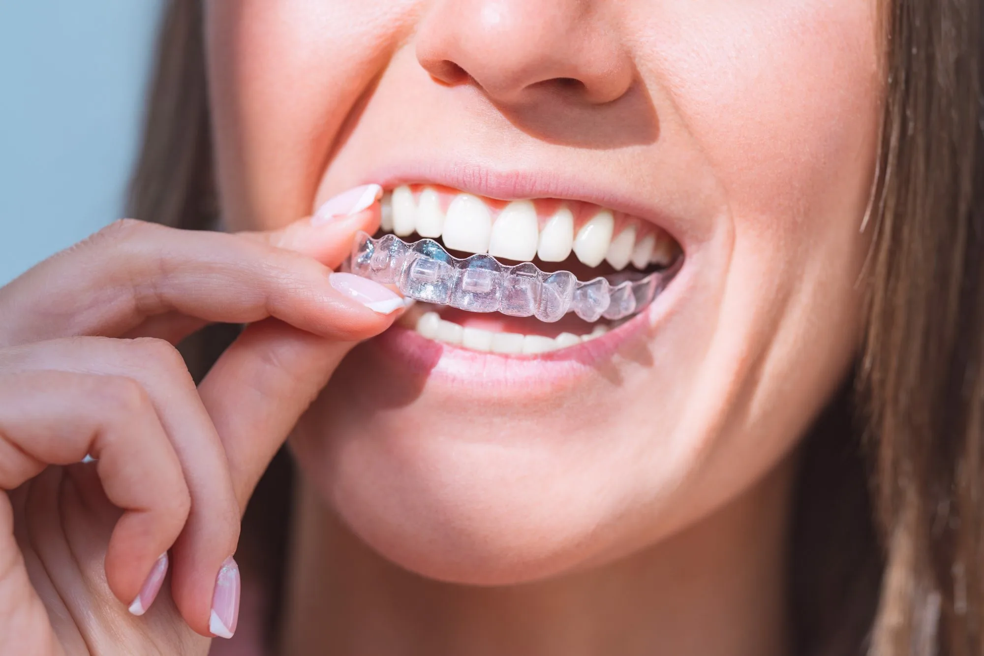 Невидимые брекеты: Invisalign и аналоги